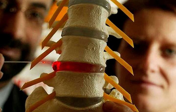 Cambios na integridade dos discos intervertebrais