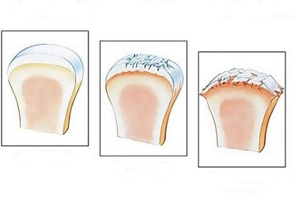 danos nas articulacións en diferentes etapas do desenvolvemento da artrose