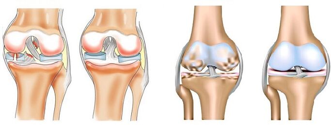 Diferenza entre artrite (esquerda) e artrose (dereita) das articulacións
