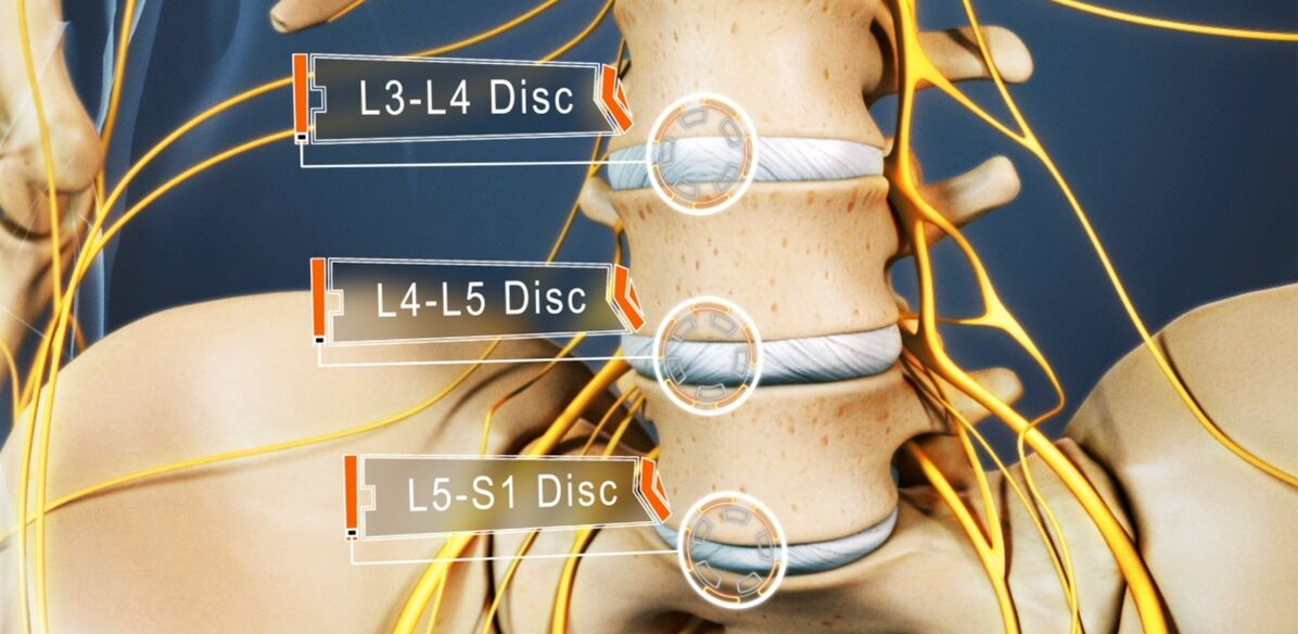 Discos da columna lumbar, que son máis frecuentemente afectados na osteocondrose