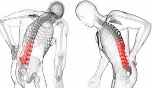 Hernia intervertebral - complicación coa osteocondrose
