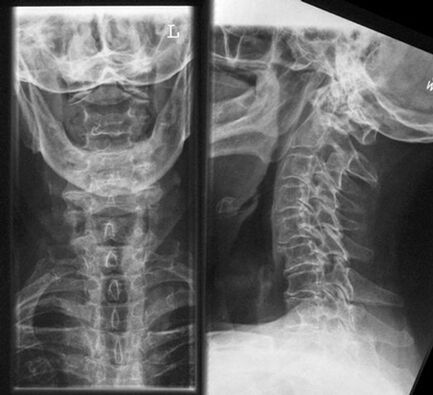 Cervical x -ray - método de diagnóstico de osteocondrose