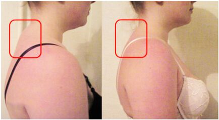 Formación de rolo muscular con osteocondrose cervical