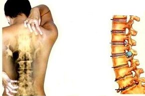 Dor de costas en diferentes etapas do desenvolvemento da osteocondrose cervical