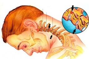 Pinching do nervio na columna vertebral con osteocondrose cervical