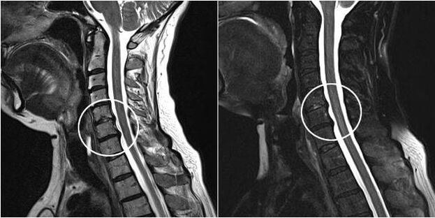 Resonancia magnética da columna cervical