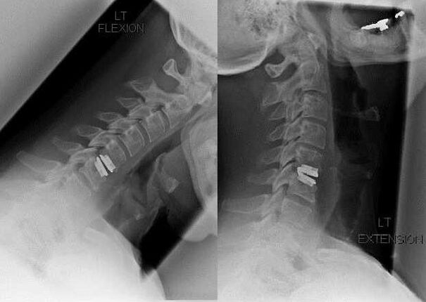imaxe da columna vertebral despois da cirurxía