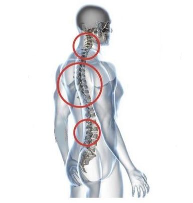 sitios de osteocondrose espinal