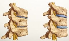 como é a osteocondrose