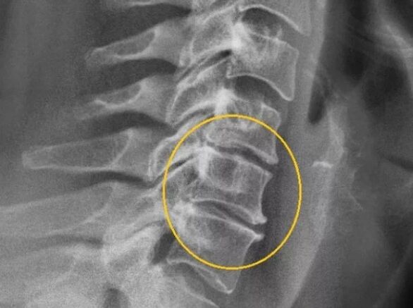 Osteocondrose da columna cervical en raios X